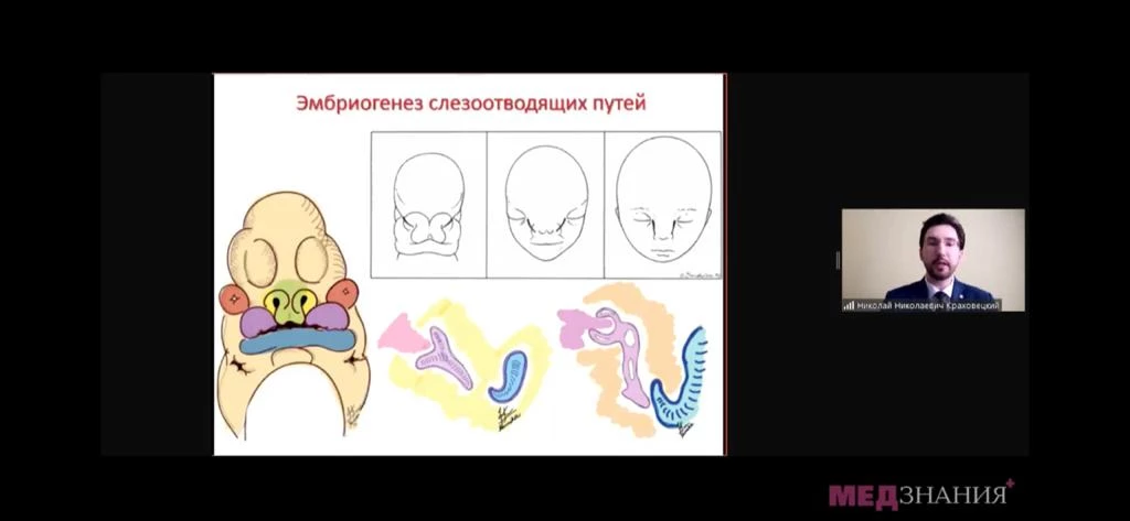 
                                                                             Медзнания.Вебинар 1 Ежегодной Конференции Российского Общества Ринологов. Дакриология детского возраста
                                                                              